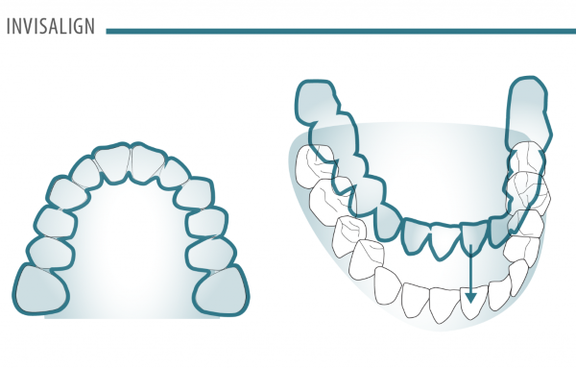 invisalign.png 