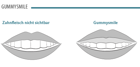 gummy-smile.png 