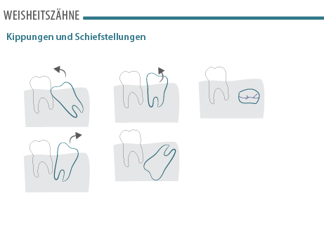 weisheitszaehne-02.png