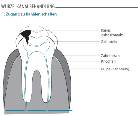 wurzelkanalbehandlung-01.png 