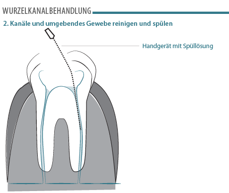 wurzelkanalbehandlung-02.png 