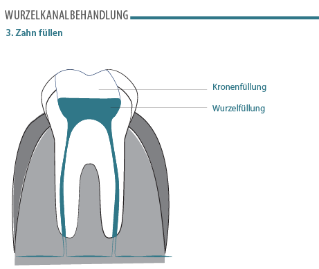 wurzelkanalbehandlung-03.png 